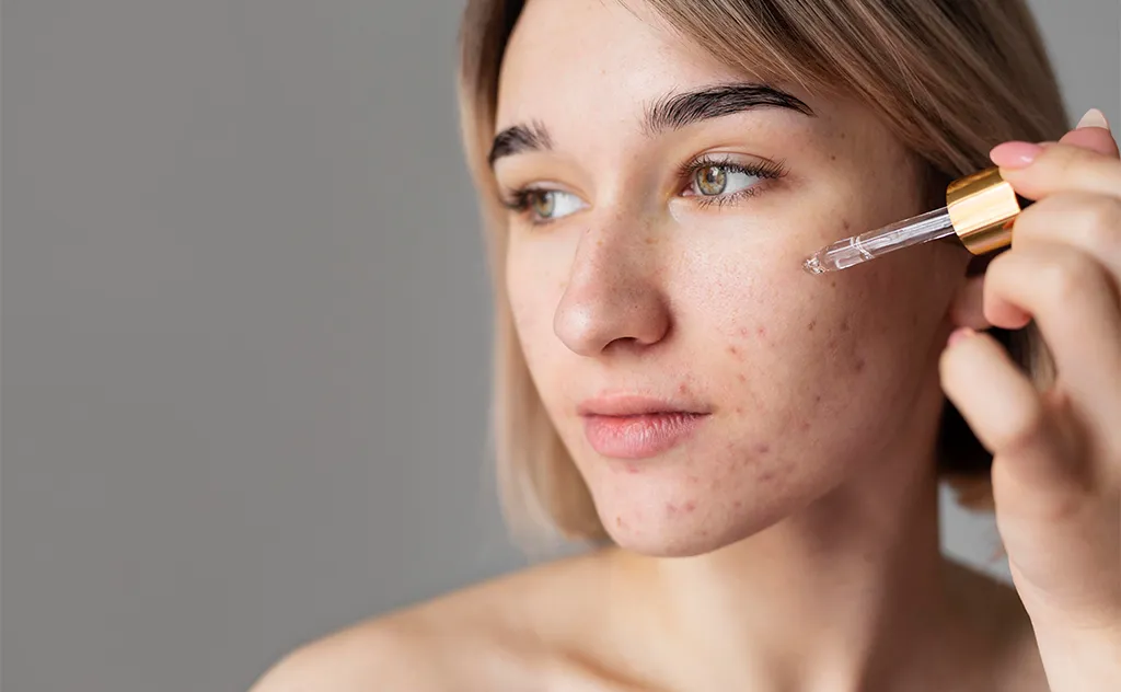 come curare l'acne in modo naturale
